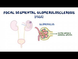 Focal Segmental Glomerulosclerosis (FSGS): Navigating the Complexities of a Rare Kidney Disorder