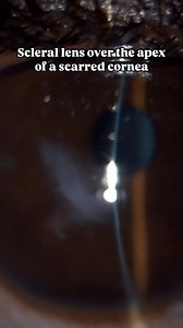 “Scleral Lens over scarred cornea of a keratoconic patient. This lens was actually bearing on the cornea and will need to be raised. . 🎥 DC4 SLD701 📐 Triton OCT” Keyur Patel (@optomegeek) | Scleral Lens Education Society