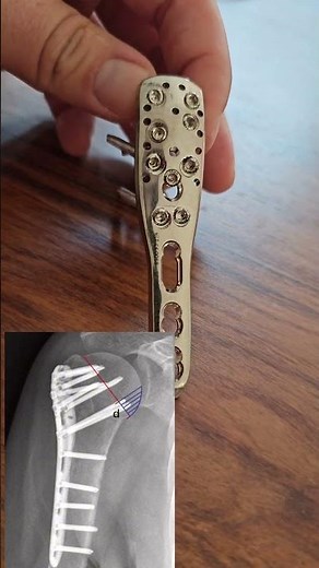 FRACTURA. De HUMERO y tratamiento con placa ANATOMICA