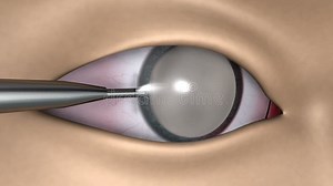 Biomedical Animation of Cataract Surgery in Human Eyes Stock Video - Video of biology, cataracts: 318916977