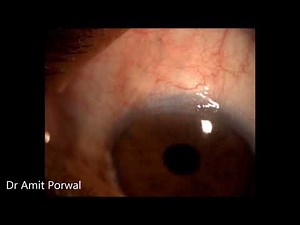 AIOC2024 - VT616 - Dr.Amit Porwal - Bleb Needling – An effective procedure for saving a failing b...