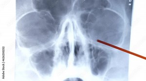An X-ray of the maxillary sinuses is studied. Inflammation of the maxillary sinuses. diagnosis