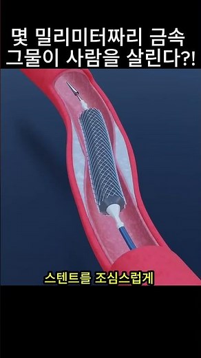 몇 밀리미터짜리 금속 그물이 사람을 살린다?! 막힌 심장 혈관을 단숨에 뚫어주는 스텐트 시술의 경이로운 공학적 원리 🫀🩺💡#의료공학 #심장스텐트 #혈관건강 #의학지식 #심혈관질환