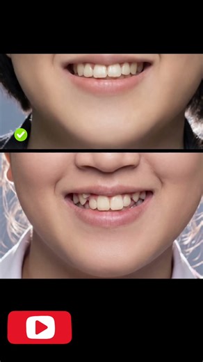 “Amazing Teeth Correction Transformation | Before & After Orthodontic Fix”