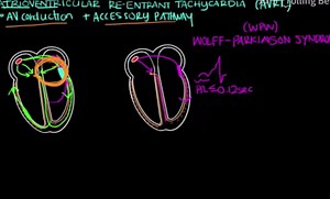 心电图：房室折返性心动过速(AVRT) & 房室结折返性心动过速(AVNRT)