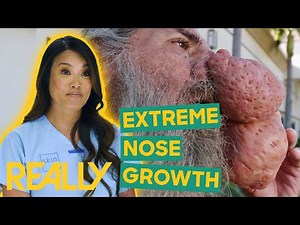 Dr. Lee Sees Man With An Extreme Nose Growth | Dr Pimple Popper: Pop Ups