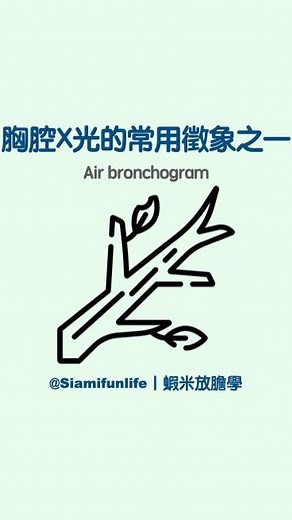 蝦米放膽學｜醫事放射師 on Instagram: "【影像判讀—air bronchogram】 air bronchogram （空氣支氣管圖）是指支氣管內充滿空氣，但鄰近肺泡組織已經被其他物質填滿（滲透液、水或血）；平時的看不到細支氣管，因為支氣管及旁邊的肺泡都充滿空氣；肺實質若填充其他物質無空氣，相對於細支氣管內的空氣會被顯相出來。 造成air bronchogram 的原因很多，常見的是肺實質化、肺水腫。 #放射師 #胸腔攝影 #空氣支氣管像 #chestxray #airbronchogram"