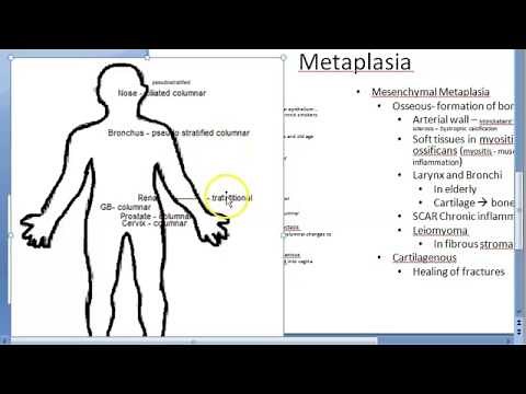 Pathology 038 a Metaplasia types Cell adaptation atrophy hypertrophy hyperplasia squamous columnar