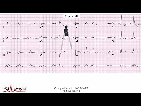 Advanced 12-lead ECG / EKG Analysis - ChalkTalk #600
