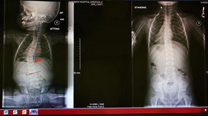 Special cast gives kids with scoliosis a chance at normal life