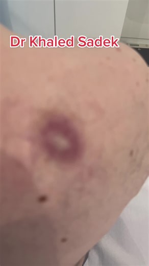 Infected back cyst #cystremoval #drkhaledsadek #SkinCare