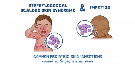 Video: Staphylococcal scalded skin syndrome and impetigo: Clinical sciences - Video Explanation! | Osmosis | Osmosis