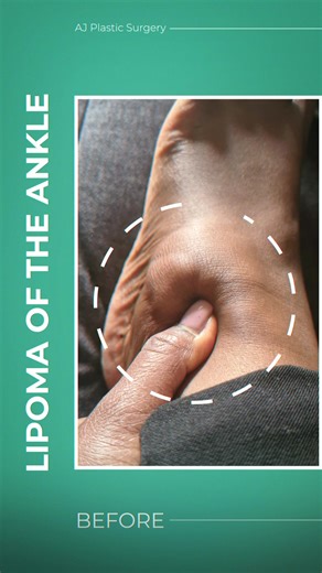 Before and After Lipoma removal. A lipoma on the ankle can be uncomfortable for several reasons: Pressure: The lipoma may put pressure on the surrounding tissue, causing discomfort and pain. Friction: If the lipoma is located in an area where it rubs against clothing or other body parts, it can cause irritation and discomfort. Nerve compression: A lipoma on the ankle can press on nearby nerves, causing pain, tingling, or numbness. Increased size: As a lipoma grows, it can cause discomfort due to