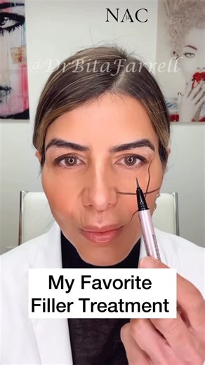 Dr. Bita Zadeh Farrell on Instagram: "One of my absolute favorite treatments for women, men, and myself is cheek restoration. The deep medial cheek is one of the first areas where we lose volume as we age. This subtle hollowing flattens the midface, blunts the OGEE curve, and reduces the natural support beneath the under eye. By restoring this deep fat pad, we rebuild the hammock of support that lifts and refreshes the entire midface without creating a “filled” look. The lateral cheek then adds 