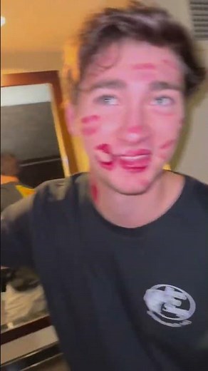 Bro what happened in your face? | #memes