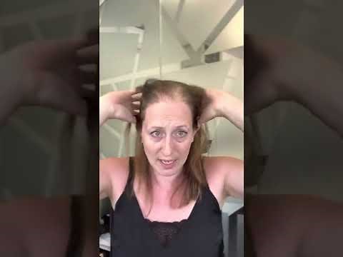 My hair loss journey with androgenetic alopecia (female pattern baldness) and why I wear toppers