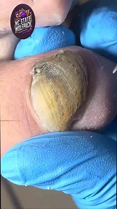 Safe Nail Routines for Long Overgrown Toenail Maintenance 💝💓 #HomeNailCare #FootSupport #FootCareTips | NC State Wolfpack on TheWolfpacker.com