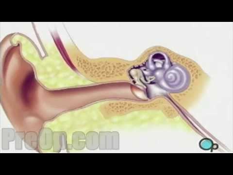 Myringotomy Insertion of Tube Surgery PreOp® Patient Engagement and Education