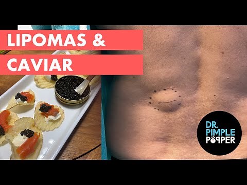 Lipomas & Caviar