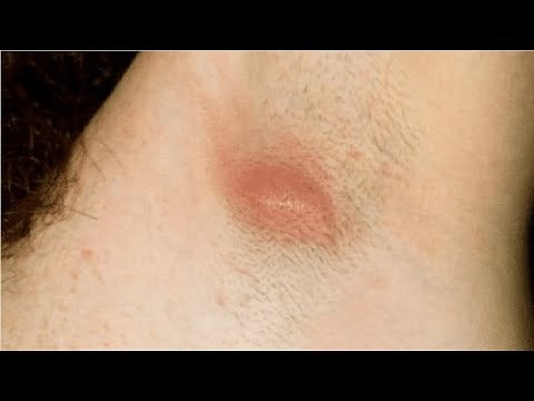 how to get rid of an ingrown hair bumps armpit