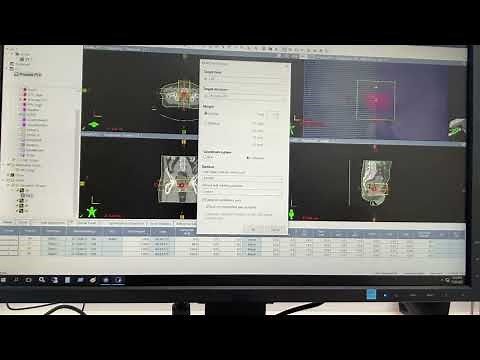 3D-Conformal Radiotherapy (Box Technique) for Prostate Cancer Treatment