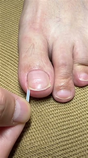 Foot care #toe splitter #toe overlap 1011u0