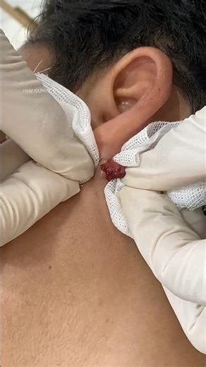 Nặn mụn nhọt sưng như trứng cút ở tai.