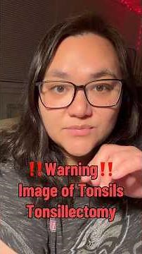 🤢 Tonsillectomy - I Got My Tonsils Removed… Here’s My Before & After (2 Weeks Later)