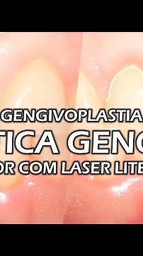 Plástica Gengival - Gengivoplastia sem dor com Laser Litetouch