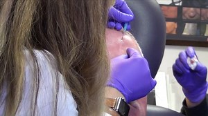 Thread-Lift Non-Surgical Facelift Procedure