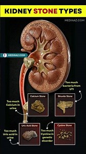 This Is What Kidney Stones Actually Look Like! 😳