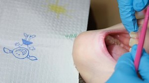 Close up shot of professional scaling kid teeth. Dental hygiene. Teeth tartar and calculus deep cleaning. Professional teeth cleaning. Teeth treatment in child dental cabinet. Work Dentist. Healthcare