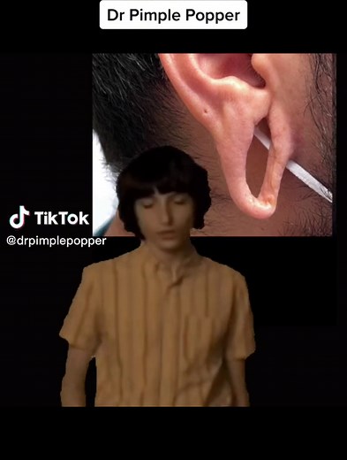 Before & after my patient came to see me for an earlobe repair surgery☺️✨ #popaholic #oddlysatisfying #popaholicsunite #drpimplepopper #slmdskincare #popaholics #earloberepair #earlobereconstruction #CapCut