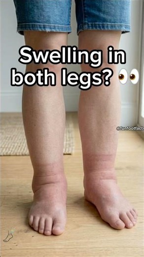 Swelling in Both Legs? It’s Not Always Normal 👀