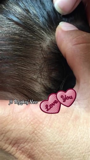 so addictive 🥰 #ticklice #lice #piojos #Spain #Brasilia | lice