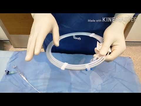 Embolization by Coils