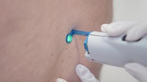 Cherry Angiomas Removal using V-Beam Laser | Clinique Chloe