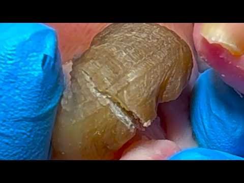 Just twist the curled toenails once and cut them off instantly!【Pedicure King】