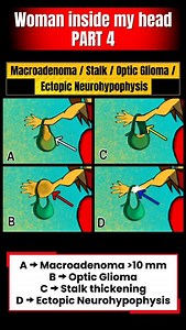 Woman in My Head Part 4: Ventricles, Pituitary, Pineal & Vascular Lesions Simplified” Use the woman in the head trick to learn: Central neurocytoma, empty sella & pituitary lesions, pineal cysts & tumors, and posterior circulation aneurysms. A visual guide packed with high-yield MRI patterns for exams and clinical practice! #WomanInMyHead #CentralNeurocytoma #PituitaryLesions #PinealTumors #PosteriorCirculationAneurysms | Adeel Ur Rehman