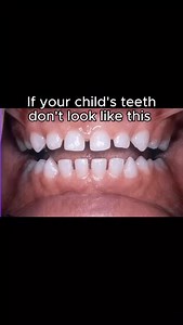 Your Child’s Mouth Is Telling a Story, Are You Listening? Your child’s mouth is more than teeth it’s a window into their nervous system. Tongue posture is central to this. When the tongue rests low or doesn’t press against the roof of the mouth, it alters facial development, disrupts breathing, and throws off posture. What looks like crowded teeth or a soft jaw is often the body adapting to poor input. The nervous system doesn’t wait it compensates. And those compensations show up early in the f