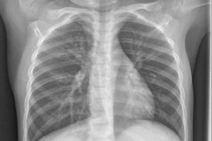 CLOUD APP FOR PNEUMONIA DETECTION  GIVEN X-RAY IMAGES IN DL