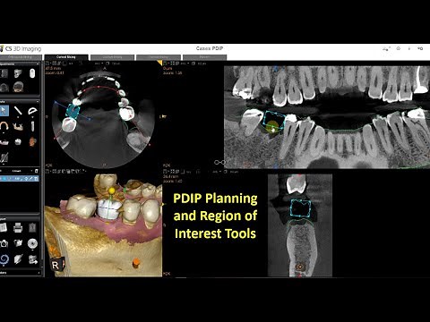 CS 3D Imaging Version 3.10.12 - Implant Planning Part 3 - PDIP Planning and Region of Interest Tools
