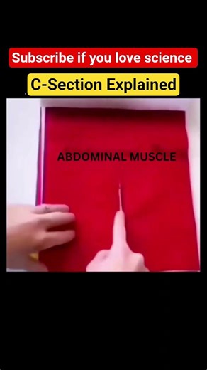 C-Section Explained (layers)