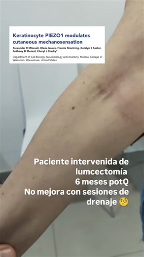 Guillem Roger Gil Miralles on Instagram: "LUMCECTOMÍA Y FISIOTERAPIA NEUROCOGNITIVA 🧠 🧐 Una lumpectomía de mama es una cirugía para extirpar un tumor y un pequeño borde de tejido sano circundante, pero no toda la mama. También se conoce como cirugía conservadora de la mama o mastectomía parcial y es un procedimiento para diagnosticar o tratar un tumor (cancerosa o no, como un fibroadenoma). En la mayoría de los casos, el objetivo es preservar la mayor cantidad de tejido mamario posible y, para