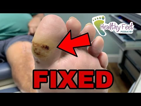 How to fix a Diabetic Foot Ulcer FOREVER! Plantar Fasciotomy for Hallux Ulcer