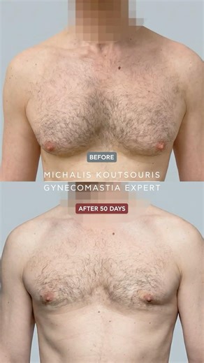 Gynecomastia Grade 2 - Before / After Transformation Snapshots