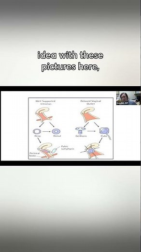 When to Choose a Gel Horn Pessary: Expert Insights