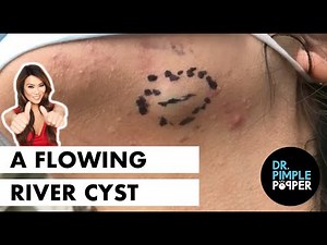 A Flowing River Cyst