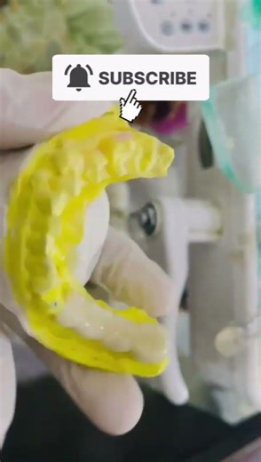 It Was So Difficult To Cement This Dental Bridge #dentist