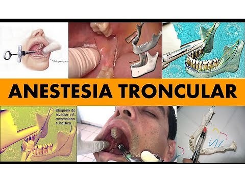 "ANESTESIA TRONCULAR"